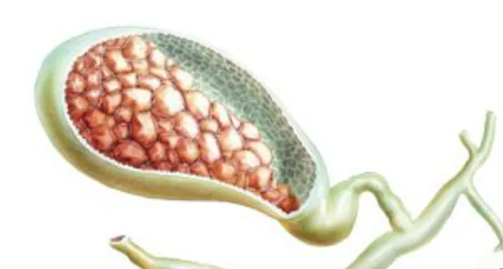 Pancreatic Stones