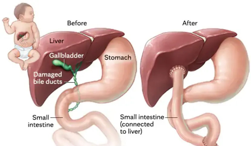 Pediatric Hepatobiliary Surgery (Kasai Procedure)